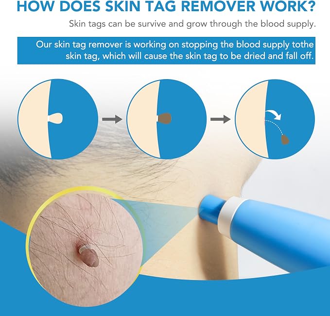 Painless Skin Tag Removal Kit