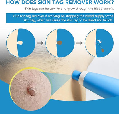 Painless Skin Tag Removal Kit