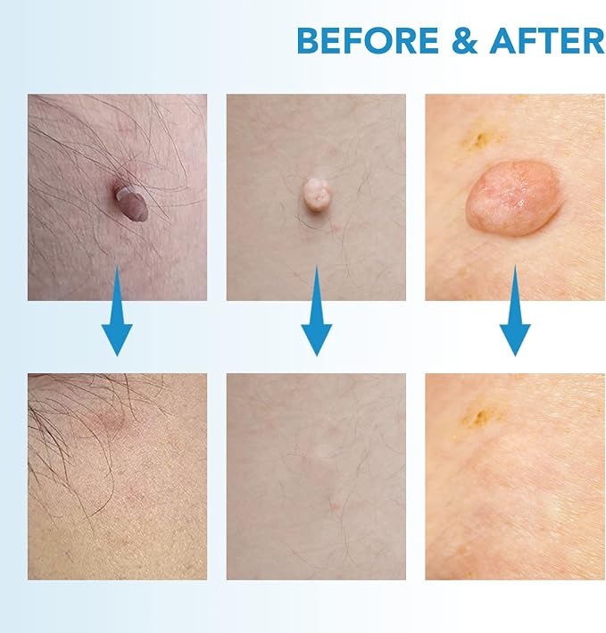 Painless Skin Tag Removal Kit