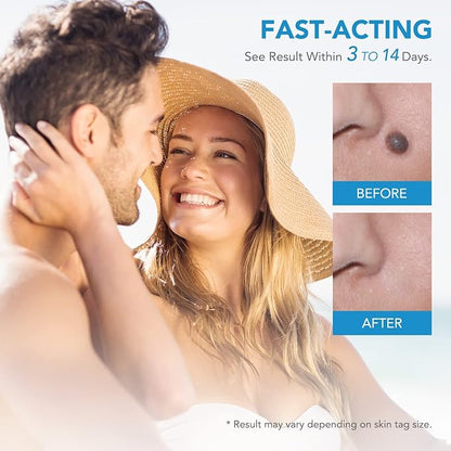 Painless Skin Tag Removal Kit