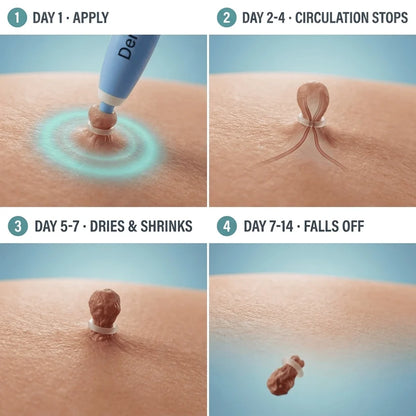 Painless Skin Tag Removal Kit