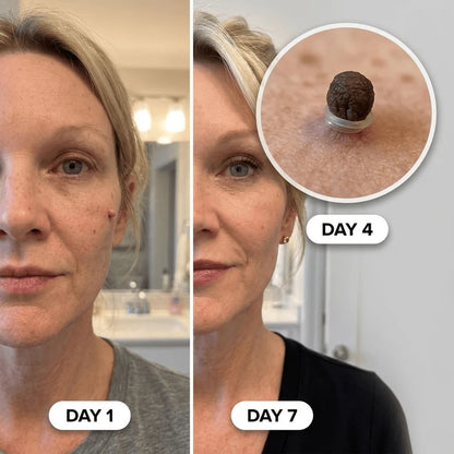 Painless Skin Tag Removal Kit